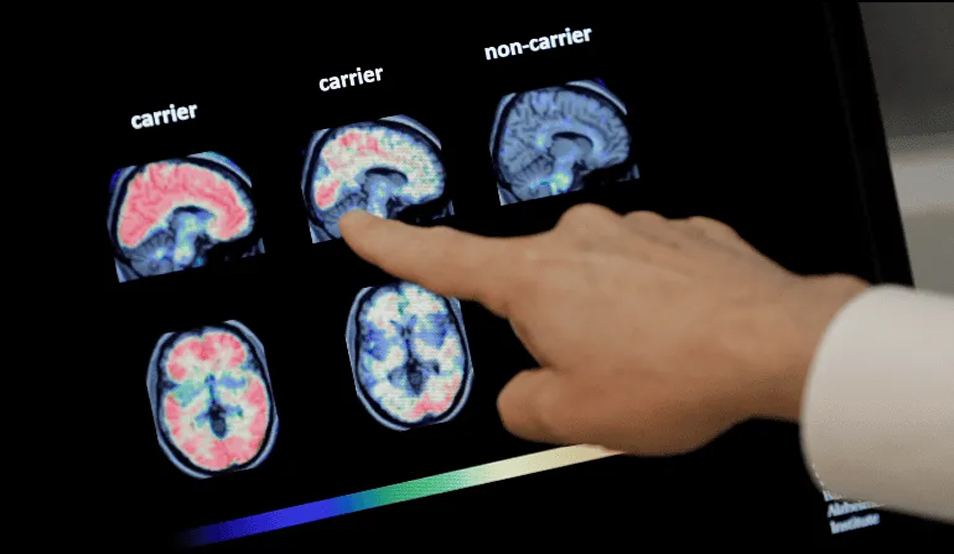 ALZHEIMER
